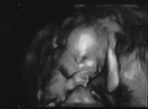 Ultrasound Image